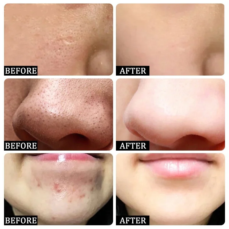 Salicylic Acid Pore Clearing C - Salicylic Acid Blackhead Remover บทวิจารณ์และราคา